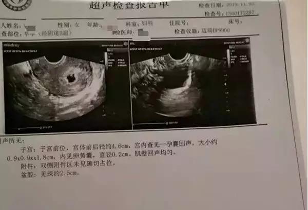 男子结扎两次妻子仍然怀孕了（妻子却查出怀孕）(1)