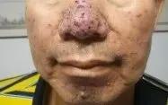 靶向藥物引起的皮膚損傷治療策略
