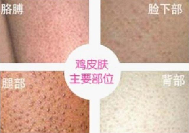 什么程度的鸡皮肤可以刷果酸