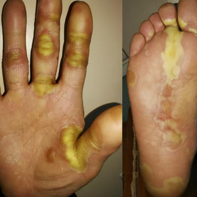 靶向藥物引起的皮膚損傷治療策略