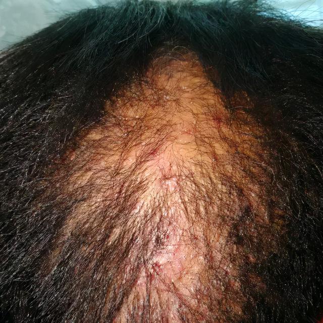 靶向藥物引起的皮膚損傷治療策略