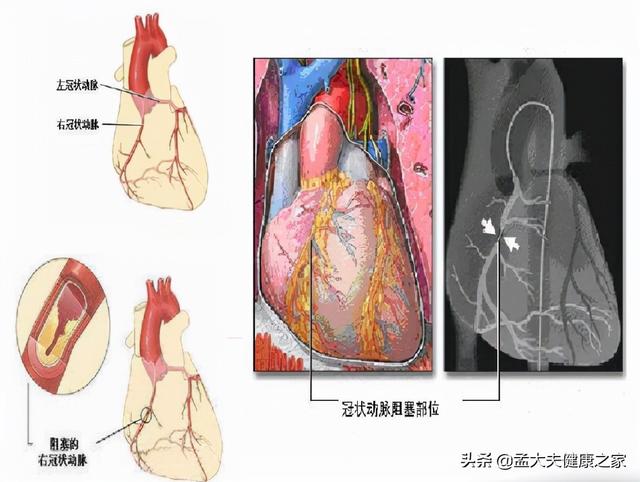 冠心病、心绞痛根在血脉不通，2个成药理气活血化瘀，保护心血管