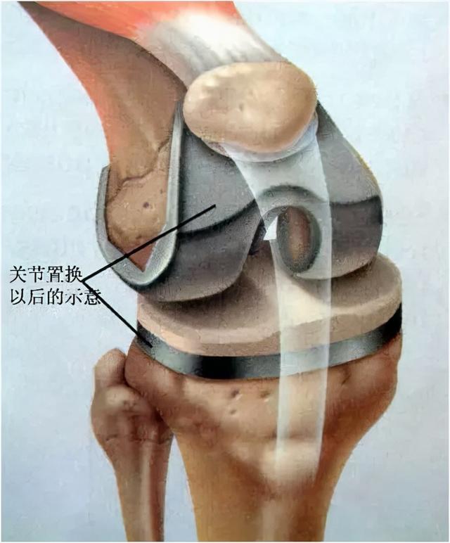 关节软骨的位置图片