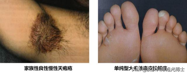 掌趾角化遗传方式