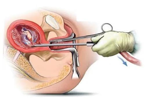 早孕人工流产和中孕引产手术操作过程及风险