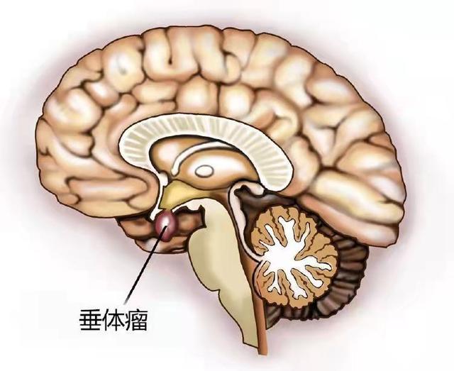 内分泌失调不孕，一查居然是垂体瘤，脑袋里的这个肿瘤你需要了解