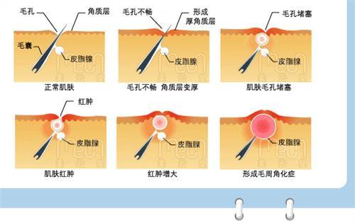 毛周角化症手臂背部