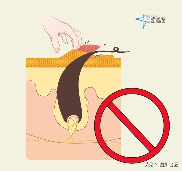 鸡皮肤好去除吗