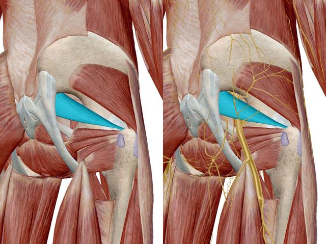 坐骨神经痛之梨状肌压迫综合症 别让这块小肌肉影响你的下半身_健康