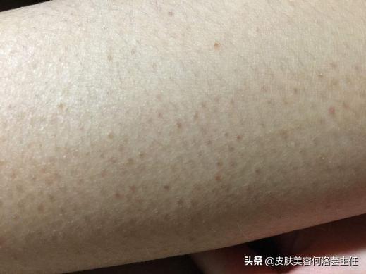 胳膊一块块鸡皮疙瘩怎么回事