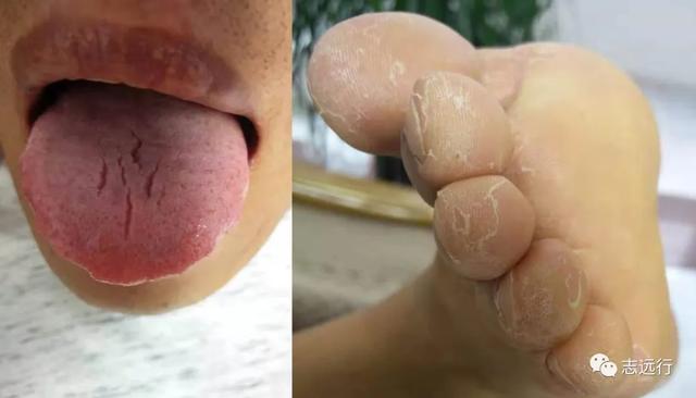 角化形手癣中药熏洗方