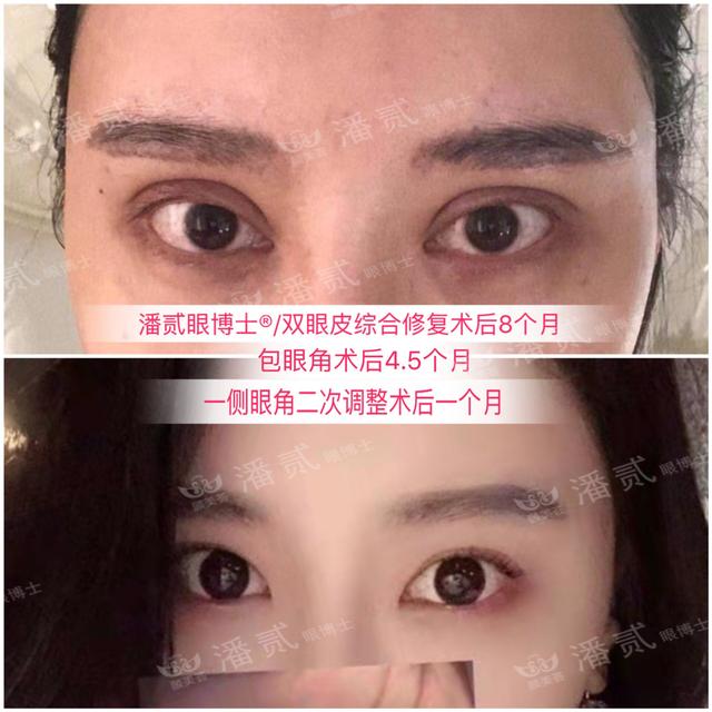 開了眼角後悔不已的案例 內眼角過大 露紅 括號 疤痕重 顯假 Kks資訊網