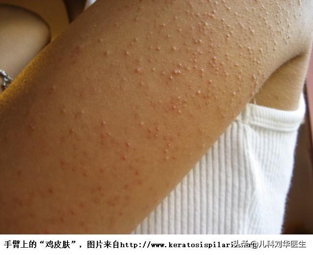 皮肤类似鸡皮疙瘩一样的图片