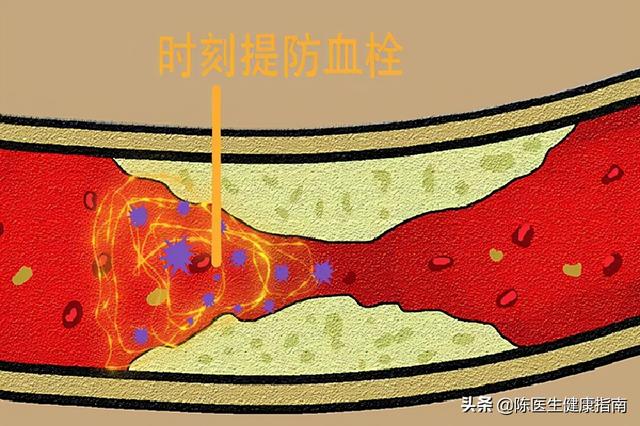 动脉硬化≠动脉粥样硬化，学好软化血管的3步骤，血流通畅少堵塞