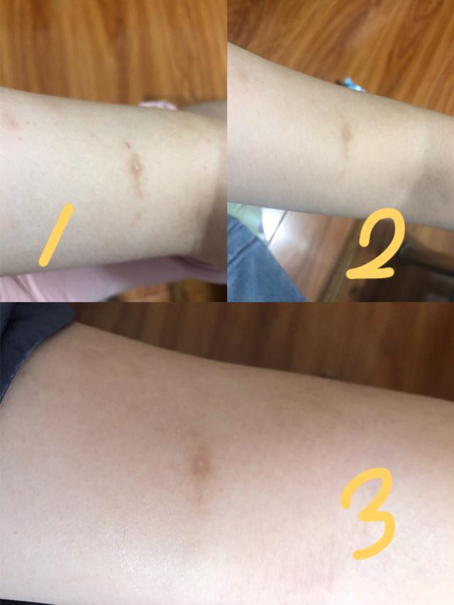 抹身体乳可以去蚊子疤吗