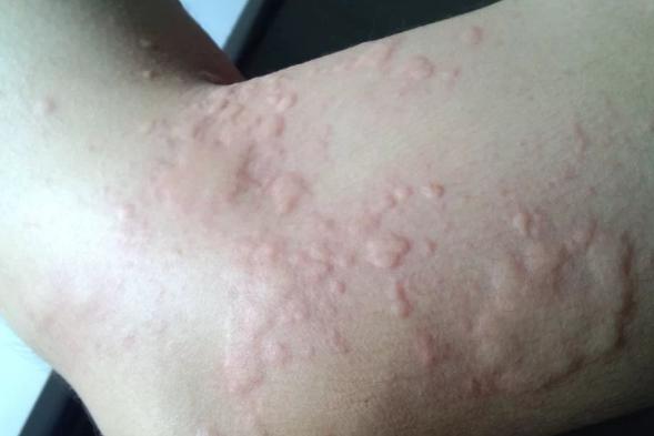 咬人的蚊子咬人的文字是公蚊子还是母蚊子