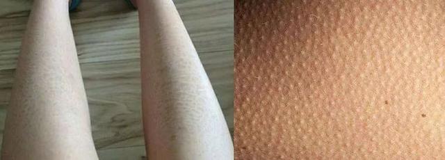 手背皮肤就长鸡皮一样