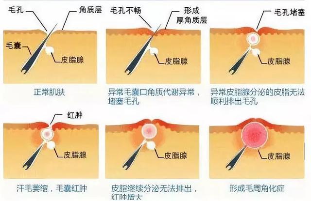 鸡皮肤只有女生有吗