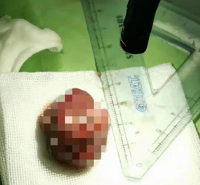 大腿鸡皮肤黑点照片