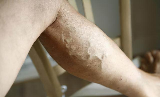 每晚坚持“踮脚”运动，半年时间过去了，身体会怎样？