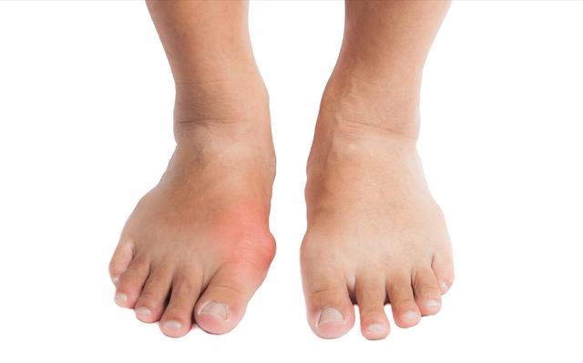 得了痛风最怕长出痛风石，该怎么避免呢？