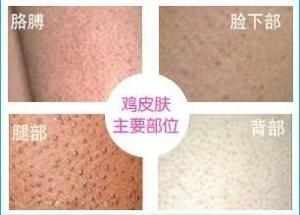 毛囊角化症怎么治愈