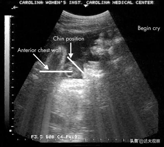 胎儿在子宫里会哭？超声波发现奇怪现象：或在出生前练习“哭泣”