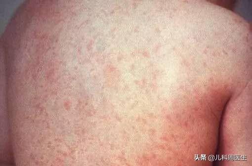 低烧怕冷两臂起鸡皮疙瘩