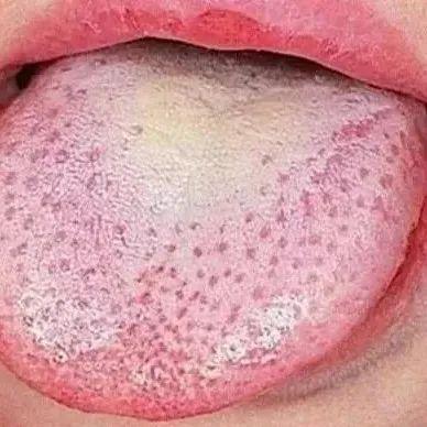 皮肤发红全身起鸡皮