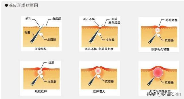 后天鸡皮肤怎么形成的