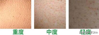 后天鸡皮肤怎么形成的