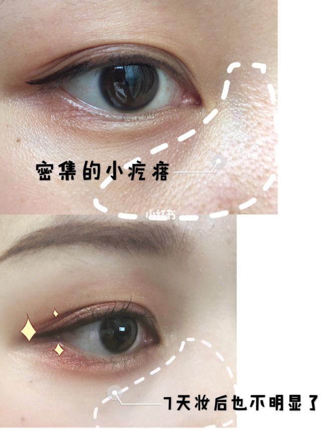 毛质角化症多大可以消除