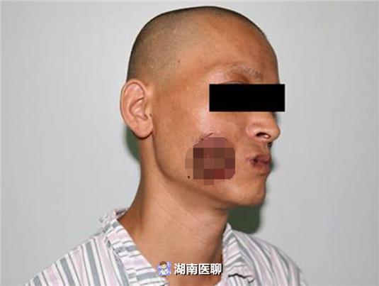 口腔黏膜角化是口腔黏膜变厚了吗