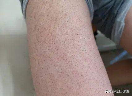 屁股有一块鸡皮疙瘩还痒
