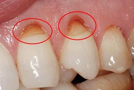 牙根暴露的人可能会出现牙齿酸痛,敏感,牙髓受损等症状.