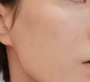 去毛周角化用什么药膏