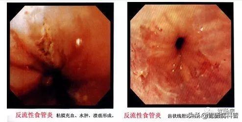 食道癌部分角化