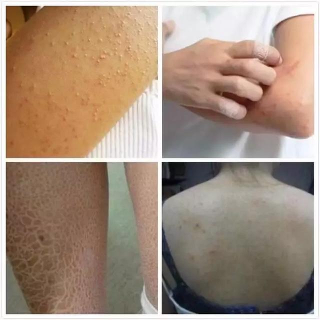 女生冬天腿上为什么会鸡皮肤很痒