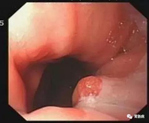 食管癌鳞癌角化型