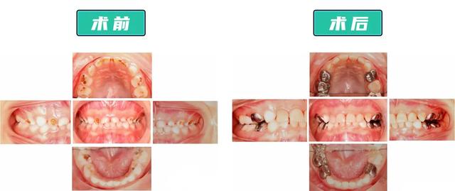 4岁娃17颗蛀牙！来这儿不哭不闹，补完牙还背起了诗