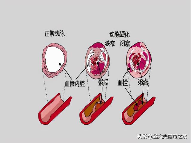 冠心病、心绞痛根在血脉不通，2个成药理气活血化瘀，保护心血管