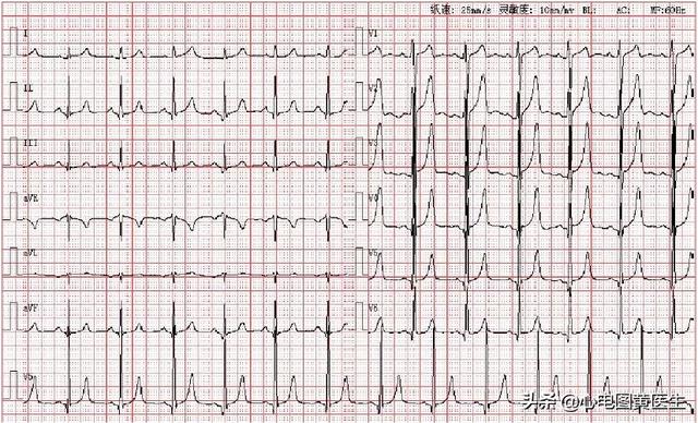 高钾血症与低钾血症心电图表现总结