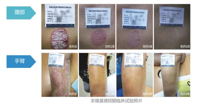 如何确诊角化湿疹