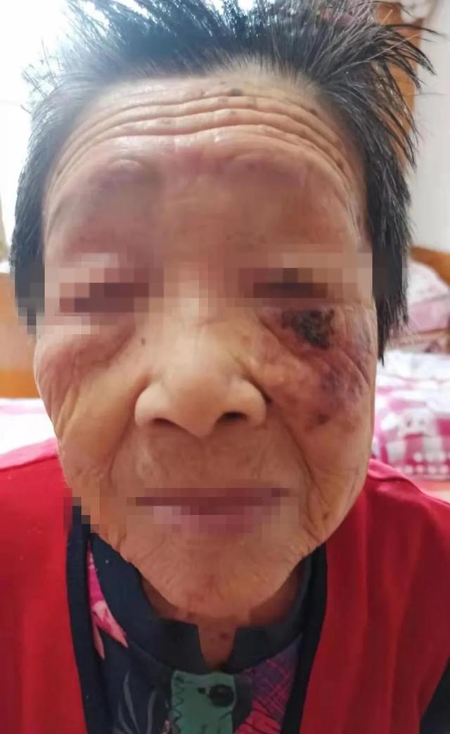 角化层鳞状细胞癌
