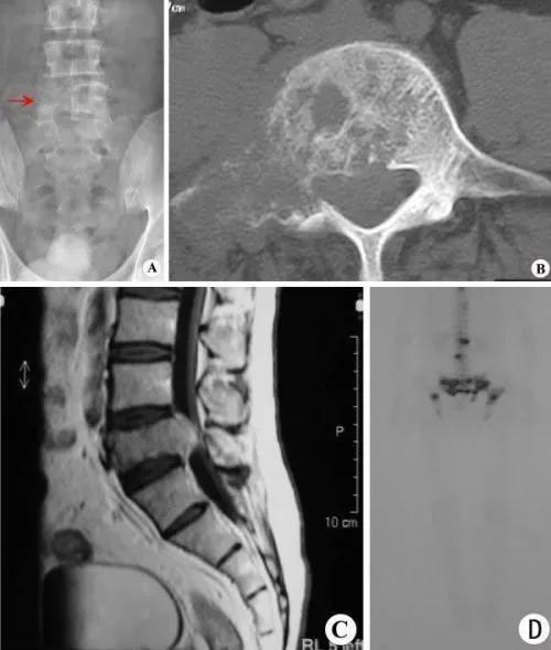 70岁以上老人患癌特点及预后