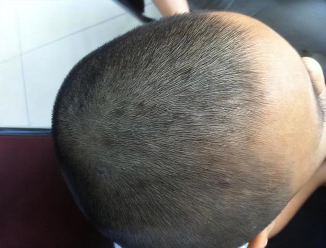 头皮上经常长脓包和疙瘩，是怎么回事？医生：3种病要考虑在内