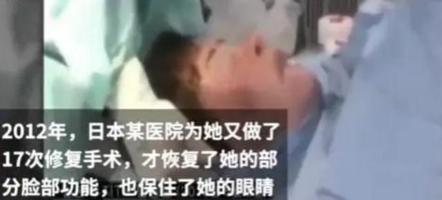 2018年韩慧景去世，年轻时在脸上注射色拉油，因整容过度几乎毁容