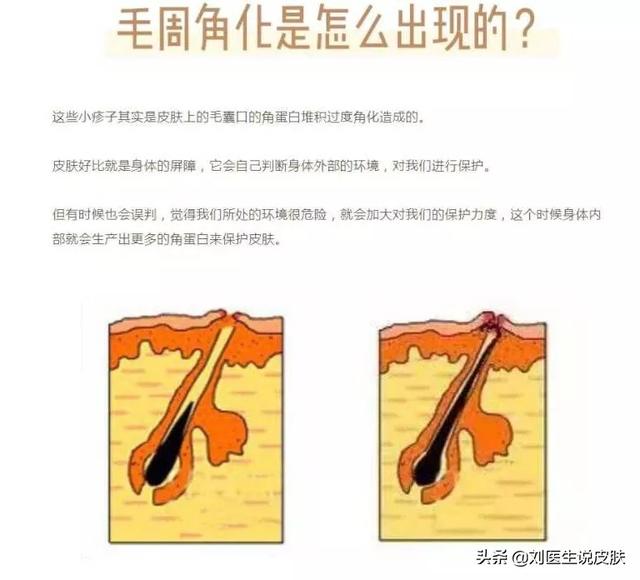 皮肤起鸡皮眼