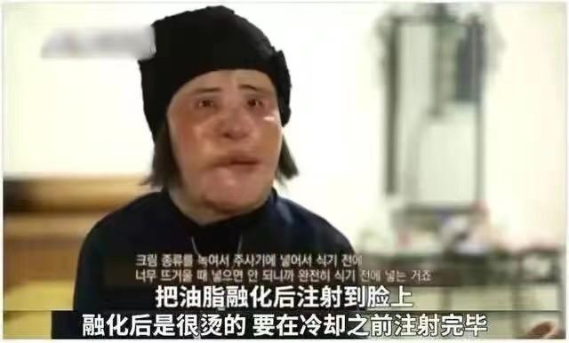 韩慧景：把自己整成“电风扇”，注射食用油代价惨痛，我悔不当初