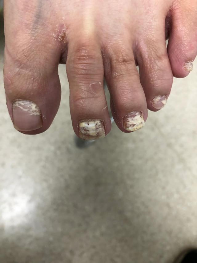 灰指甲传染吗一般多长时间,得了灰指甲